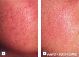 果酸焕肤精华液与果酸的区别,果酸换肤适合角质层薄的人吗