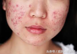 果酸焕肤精华液与果酸的区别,果酸换肤适合角质层薄的人吗