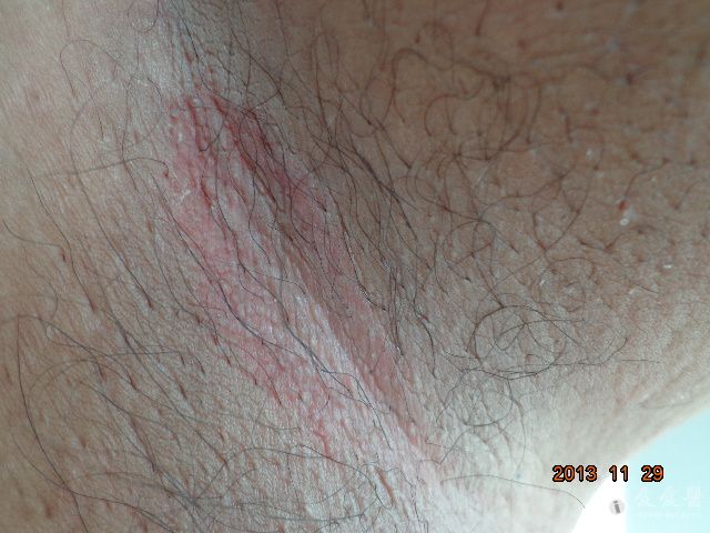 皮肤上有糖尿病的信号,皮肤上有疙瘩不好是糖尿病吗