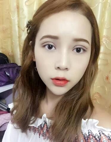 韩式三点定位恢复图片,韩式三点双眼皮恢复一个月图片