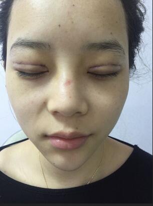 韩式三点定位恢复图片,韩式三点双眼皮恢复一个月图片