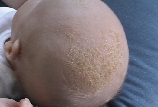 婴儿头上结痂能抹润肤霜吗,小孩脸上结痂老用手抓怎么处理