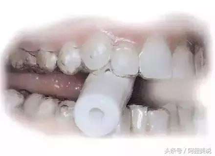 隐适美隐形矫正摘戴、保养关注事项全攻略