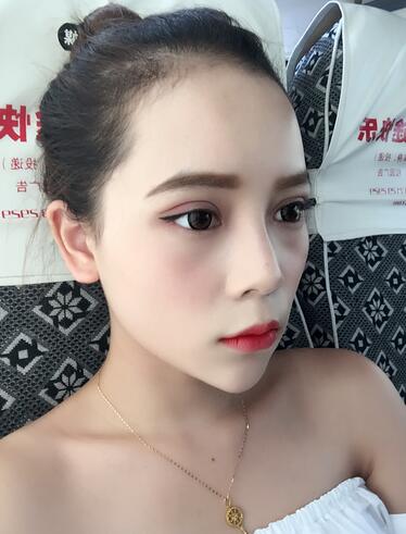 韩式三点定位恢复图片,韩式三点双眼皮恢复一个月图片