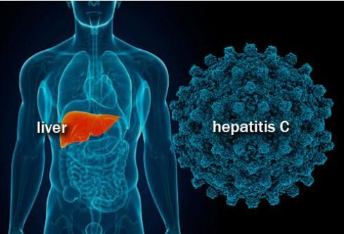 丙肝可以治愈吗还需要吃药按摩,丙肝可以治愈吗