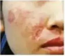 超声刀美容事实案例,超声刀美容后关注事项