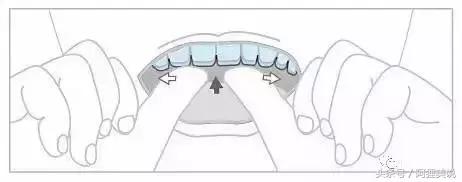隐适美隐形矫正摘戴、保养关注事项全攻略