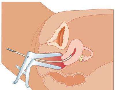 如何护理顺产侧切伤口,夏季顺产侧切怎么护理伤口