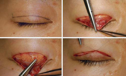 给自己点耐心：双眼皮术后一定要有一段恢复期！