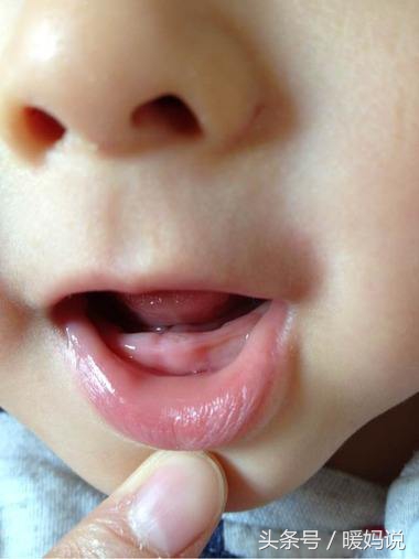 宝宝长牙疼吃什么药,宝宝长牙齿疼痛
