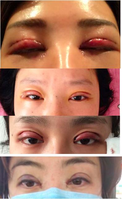 给自己点耐心：双眼皮术后一定要有一段恢复期！
