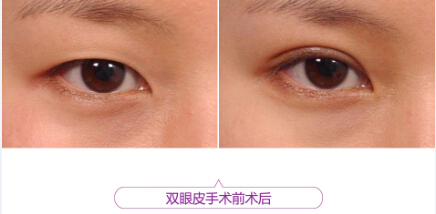 给自己点耐心：双眼皮术后一定要有一段恢复期！