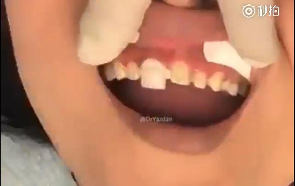 美容冠的副作用,美容冠真实缺点