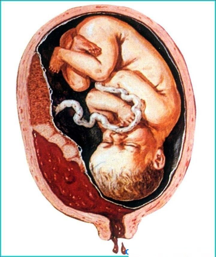 孕晚期出血但是不吐,孕晚期出血会一直出吗