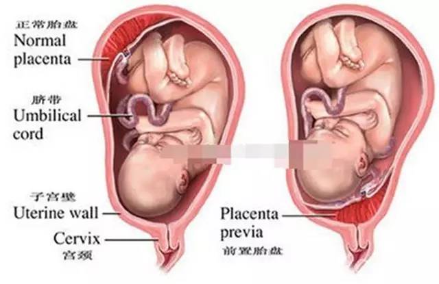 孕晚期出血但是不吐,孕晚期出血会一直出吗