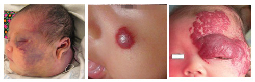 激光治疗血管瘤一次大概多少钱,新生儿血管瘤什么时候治疗最好