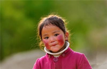 角质层薄脸红怎么调理,角质层薄大红脸怎么治