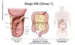 得了直肠癌怎么知道,你了解结直肠癌吗