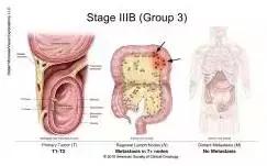 得了直肠癌怎么知道,你了解结直肠癌吗