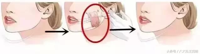 肉毒素咬肌可以完全消除吗,肉毒素能改善咬肌肥大吗