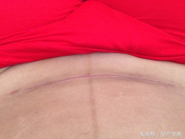 顺产侧切好还是剖腹产对女人好,剖腹产和顺产侧切对比