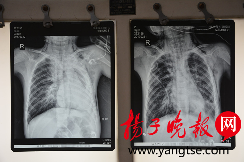 8岁男孩感冒后肺热咳嗽,8岁男孩感冒后一直咳嗽怎么办