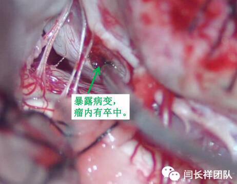 舌头突然不利索,舌头突然间不好使一会就好了