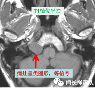 舌头突然不利索,舌头突然间不好使一会就好了