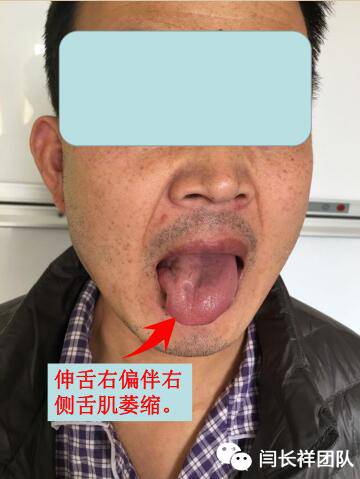 舌头突然不利索,舌头突然间不好使一会就好了