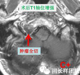 舌头突然不利索,舌头突然间不好使一会就好了
