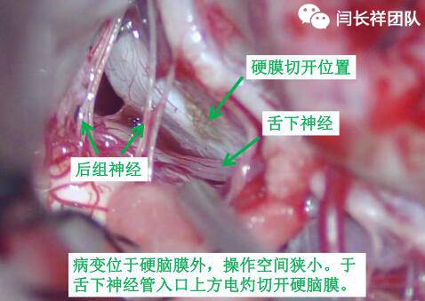 舌头突然不利索,舌头突然间不好使一会就好了