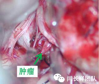 舌头突然不利索,舌头突然间不好使一会就好了