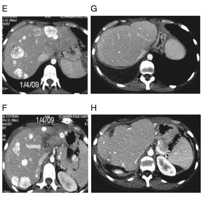 已经肝转移化疗还有救吗,海扶刀治疗肝转移瘤效果好吗