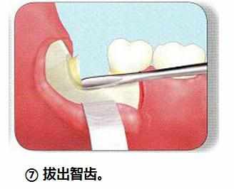 智齿横着长没露出来,智齿牙横着长怎么办