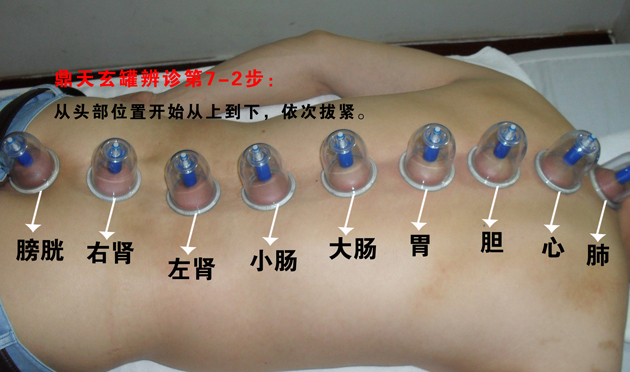 拔罐后关注事项与禁忌,你知道拔火罐用什么罐吗