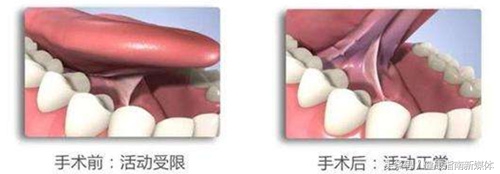 小孩舌头能伸出来是舌系带短吗,舌系带短孩子平翘舌不分怎么办