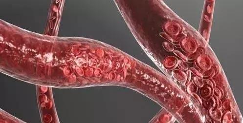 血管衰老怎么补充营养,血管衰老保健案例