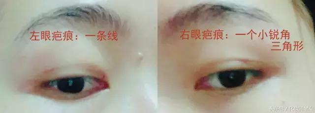 真实贴双眼皮贴,单眼皮怎么贴第二天变双眼皮