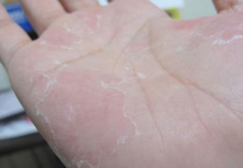 手脚脱皮是什么原因造成的，如何处理才好？