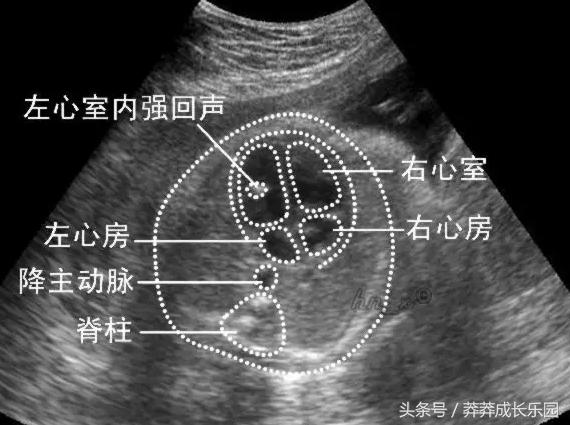 胎儿左心室有强光点怎么检查,孕中期胎儿左心室强光点正常吗