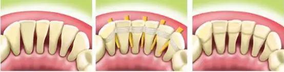 牙周病的治疗的4个程序,牙周病怎么治疗最有效好得快