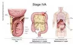 得了直肠癌怎么知道,你了解结直肠癌吗