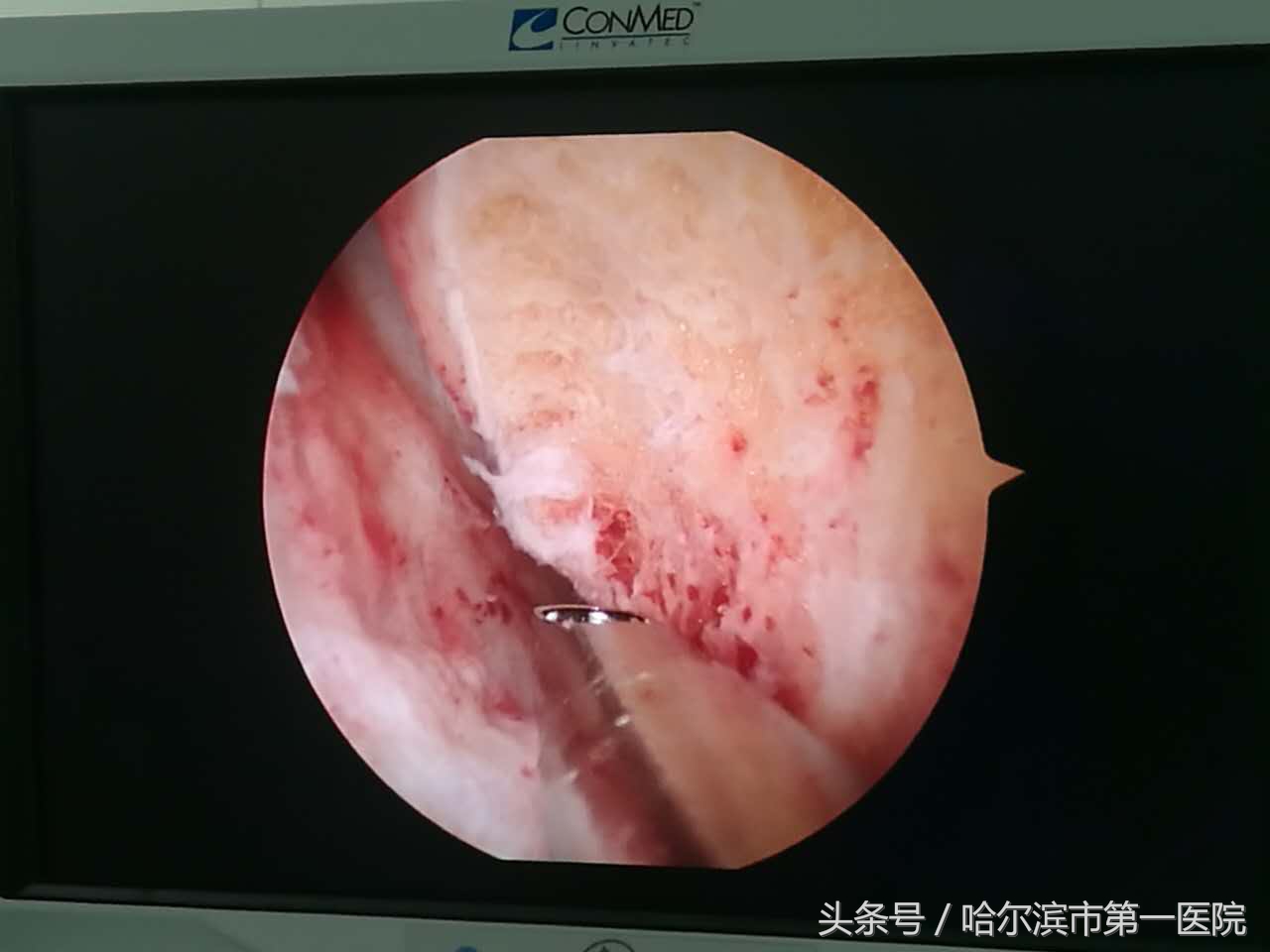 走路胯疼最快缓解方法,走路胯骨响怎么纠正