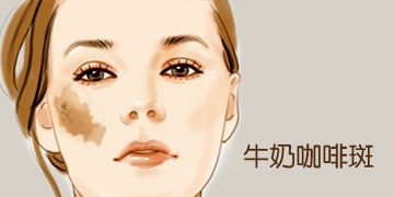 上海复大胎记医院：咖啡斑有哪些危害呢？