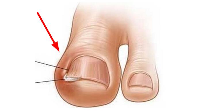 脚趾甲长肉里去了只需一招,11岁儿童脚趾甲上长肉粒怎么处理