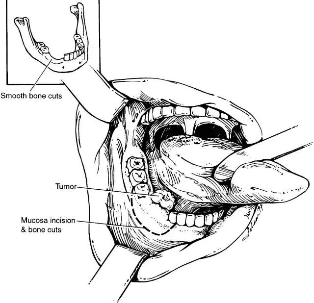 关于舌癌的新闻又一次刷屏，我想起了一年前离开的那位老人
