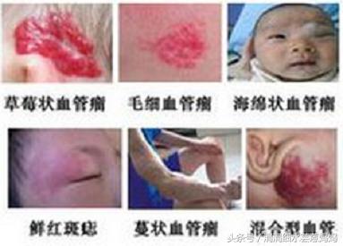 小孩胳膊有黑白花斑,小孩有一块血斑