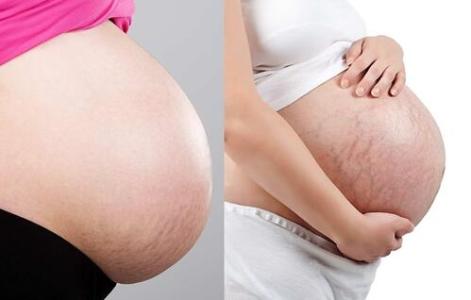 妊娠纹怎么能消除,妊娠纹怎么消除啊