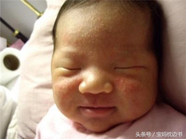 粟粒疹和湿疹有什么区别,宝宝湿疹丘疹