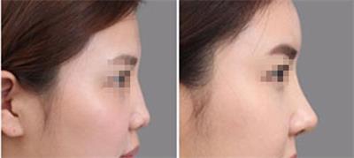 一招解决塌鼻子,教你三招摆脱塌鼻梁